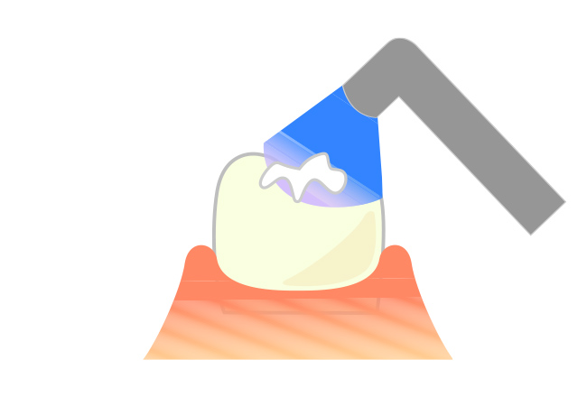 コンポジットレジンを詰めて光照射